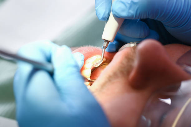 Best Emergency Dentist for Lost Fillings or Crowns in Andrews Af, MD
